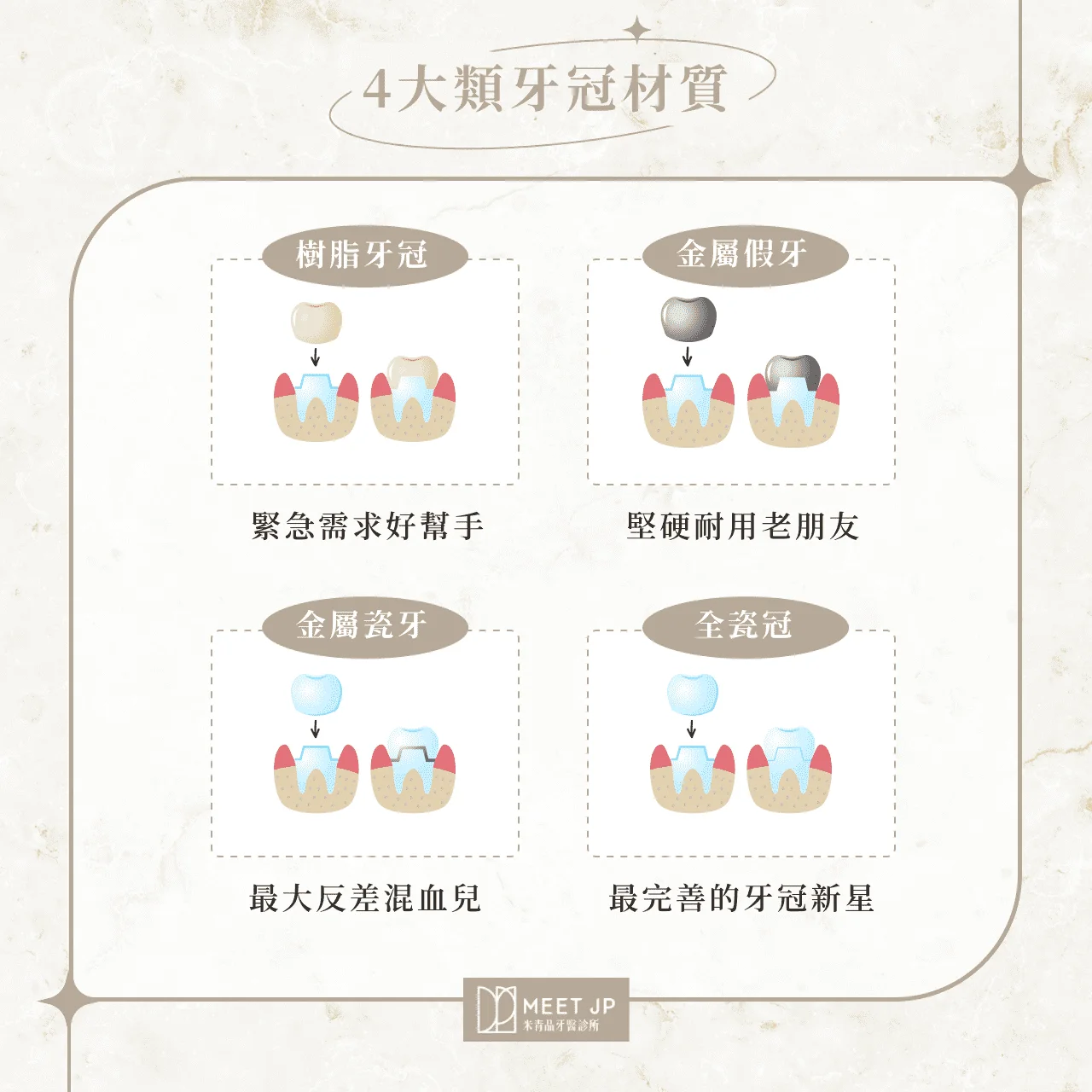4大類牙冠材質