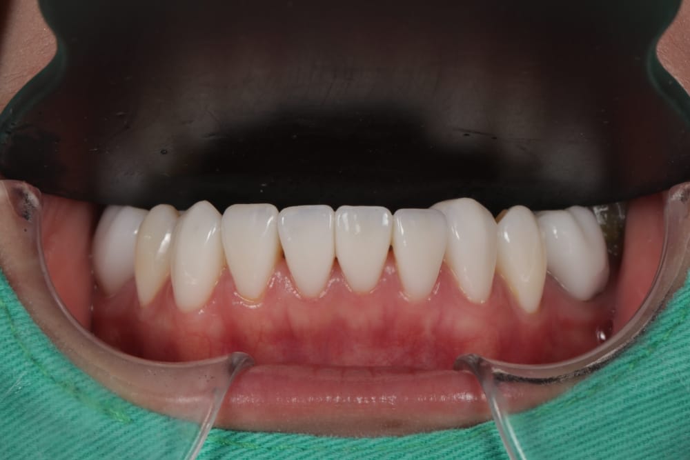 施作完的全瓷冠牙齒
