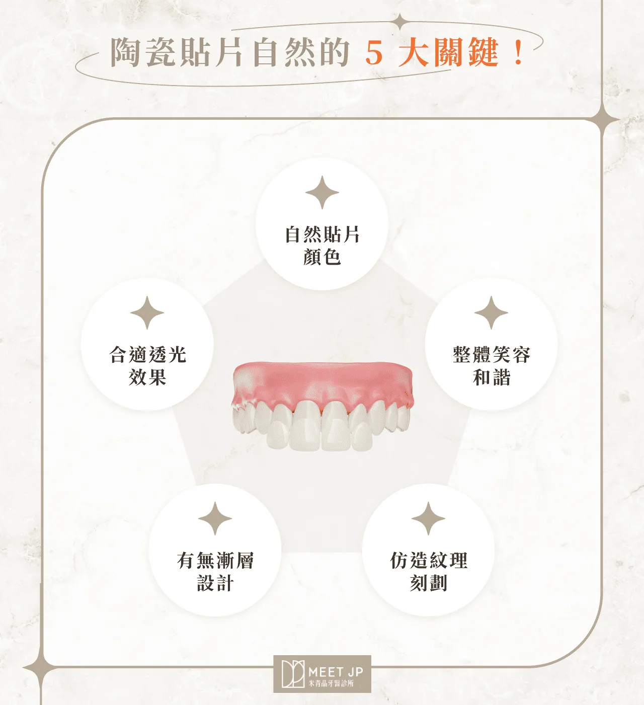陶瓷貼片自然的 5 大關鍵！