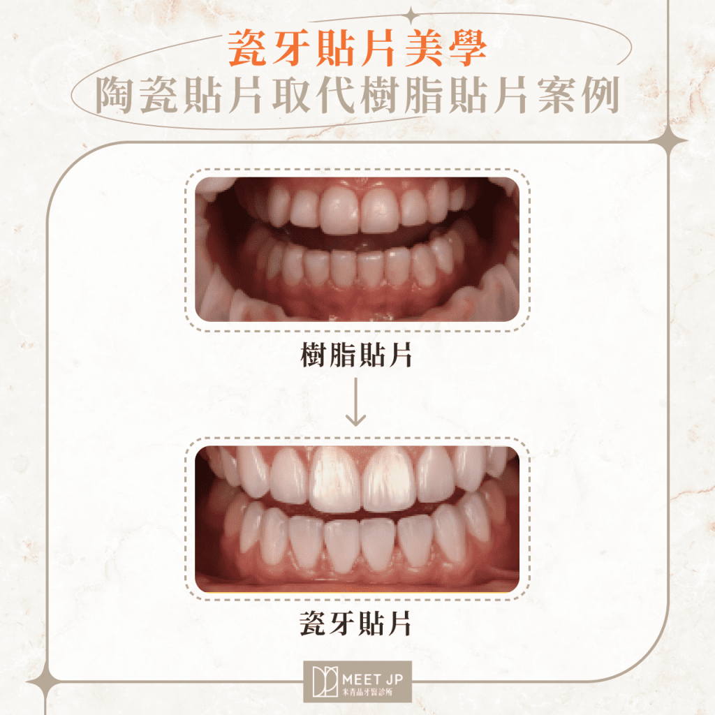 瓷牙貼片美學｜陶瓷貼片取代樹脂貼片案例圖片