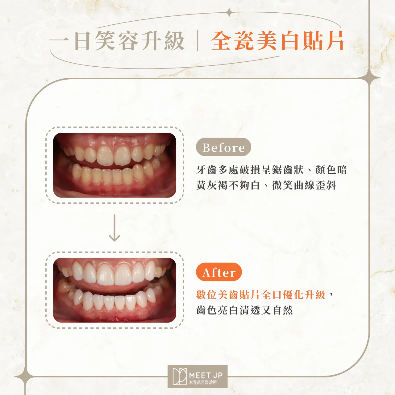 一日笑容升級｜全瓷美白貼片