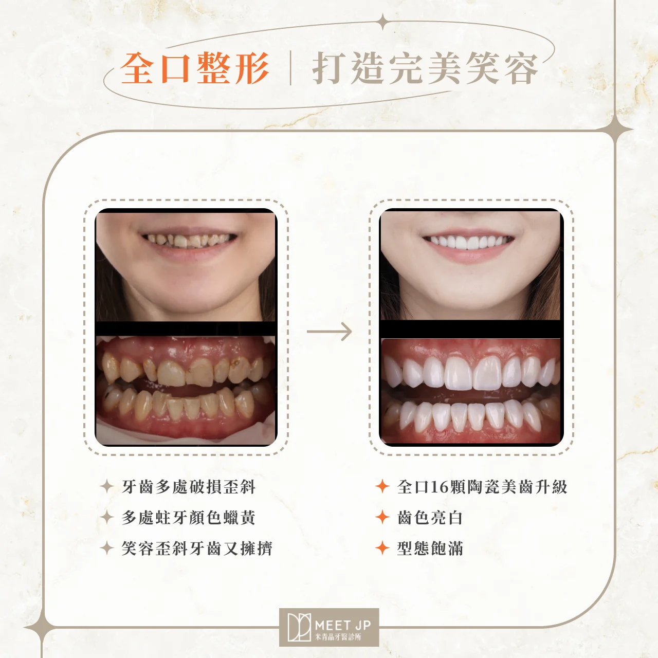全口整形｜打造完美笑容