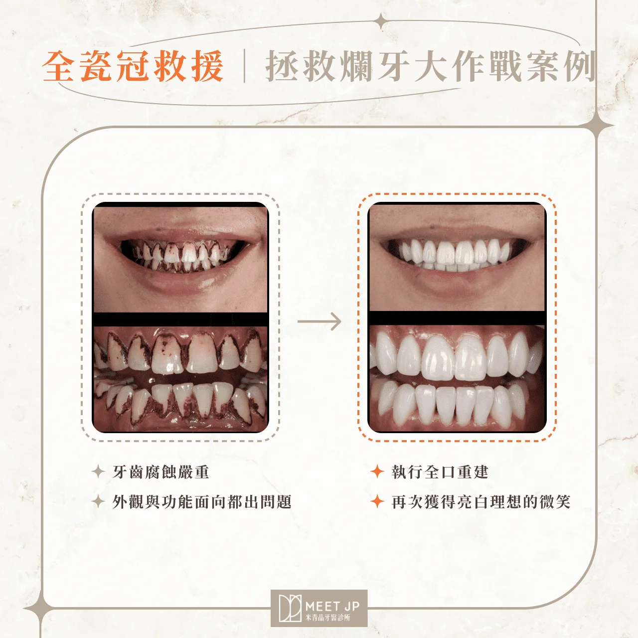 全瓷冠救援｜拯救爛牙大作戰案例