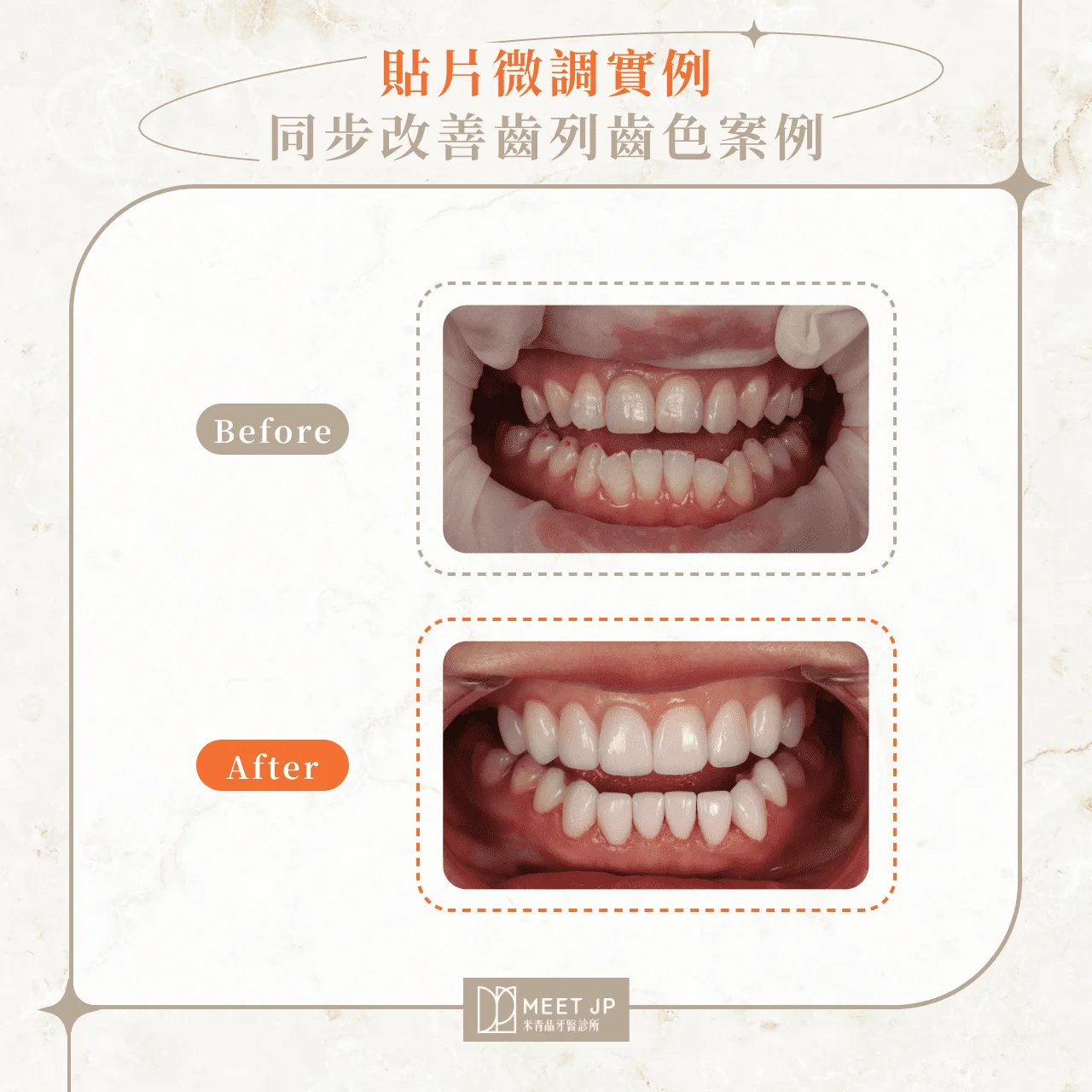 貼片微調實例｜同步改善齒列齒色