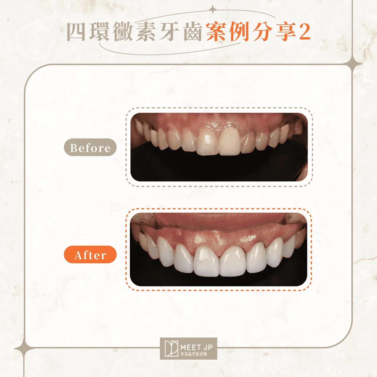 四環黴素牙齒案例分享